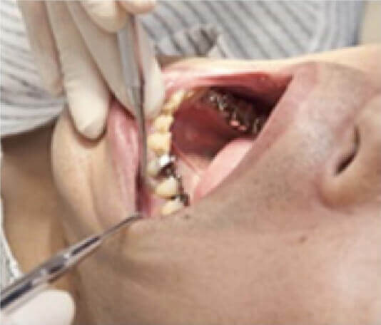 サンプルを採取